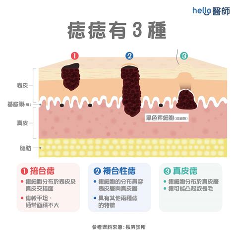 凸起來的痣|痣變大、痣多或長毛會變皮膚癌？認識痣的形成與原因